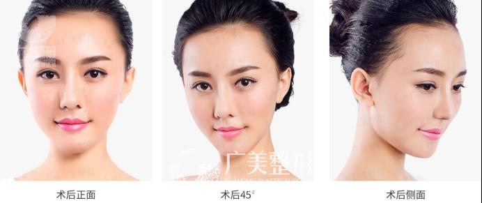 1523413983086034494.png 精致翘鼻 给整个面部锦上添花728.png