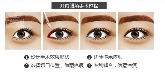1526462185268079902.jpg 开内眼角手术过程.jpg
