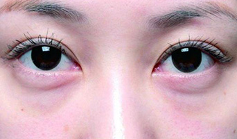你了解你的眼袋吗?